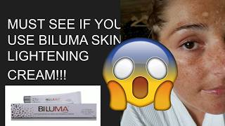 DO NOT use BILUMA without watching this video [upl. by Palua294]