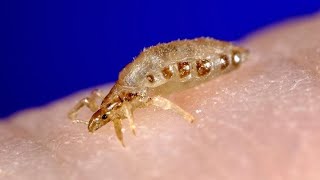 Body Lice Treatment  Symptoms and Causes  Diagnosis  Prevention [upl. by Etteiram]