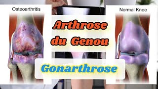 Genoux qui craquent  Voici pourquoi et comment y remédier  Arthrose du Genou enflé douloureux [upl. by Arutek]