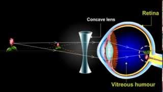 what is myopia Short Sightedness [upl. by Rivalee732]