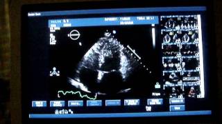 Ultrasound scan of my heart [upl. by Ikkir845]