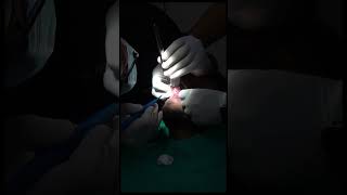 Mucocele cyst removal ytshorts maxillofacialsurgery doctor surgerycenter [upl. by Dougald]