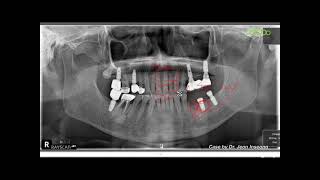 Implant removal using a special trephine bur [upl. by Alak]