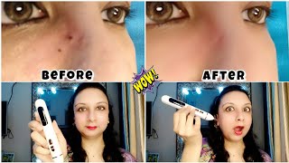 How to remove mole using mole remover pen  best product to make your skin clear mole skin viral [upl. by Neurath845]