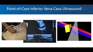 Renal ultrasound video 3 Volume status University of Florida Nephrology Dr Koratala NephroP [upl. by Alvina2]