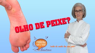 Olho de Peixe Verruga Plantar  SENSAÇÃO DE ALÍVIO 😅 [upl. by Jecho544]