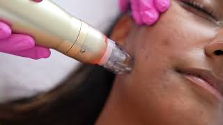 Acne Scar Treatment using RF Microneedling [upl. by Neenej]