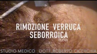 Rimozione Cheratosi con PLEXR  Dott Roberto Cicerchia [upl. by Niuq]