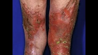 Erythema in Medicine 5 [upl. by Cleon]