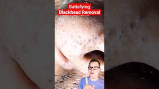 Crazy BLACKHEAD REMOVAL  Blackhead Extraction shorts [upl. by Cochran]