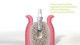 Implant Dentar Straumann PURE Ceramic  Etape [upl. by Eimia]