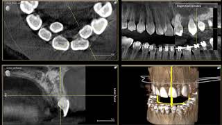 Impacted Supernumerary Extra Tooth Removal [upl. by Ribaj]