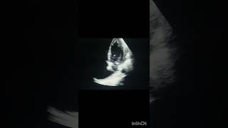 echocardiography echocardiographer echocase echo video [upl. by Aikal]