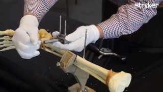 Hoffmann 3 External Fixation System How to build a Tibia Frame with Prof Seligson [upl. by Ahsatniuq37]