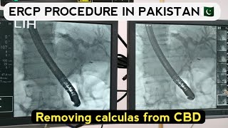 ercp stent procedure video  ercp test video in hindi Ercp in pakistan [upl. by Enneirda440]