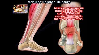 Achilles Tendon Rupture  Everything You Need To Know  Dr Nabil Ebraheim [upl. by Eednac]