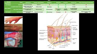 Classifying Burns EXPLAINED [upl. by Harrison]