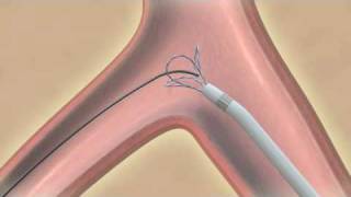 EN Snare® Endovascular Snare System [upl. by Eeluj]