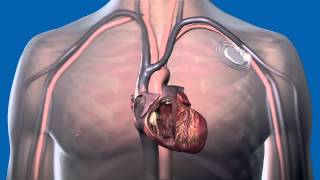 What Is a Pacemaker and How Does It Work [upl. by Cornia]