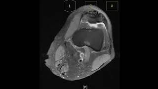 Prepatella bursitis with bursal wall thickening [upl. by Jat]