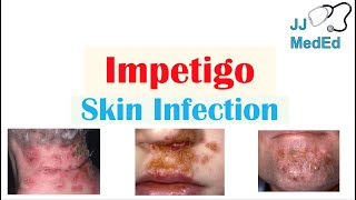 Introduction to Impetigo  Infection Subtypes and Treatment [upl. by Yllatan715]