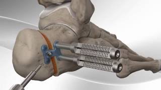 Flatfoot Repair with Arthrex® Calcaneus Step Plate [upl. by Eileen]