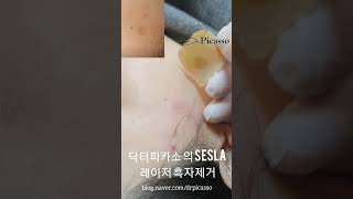 레이저 흑자 제거 치료 시술 가격 비싼 리팟레이저 아니여도 깨끗하게 제거 가능 리팟레이저lentigo laser removal treatment [upl. by Erehpotsirhc138]