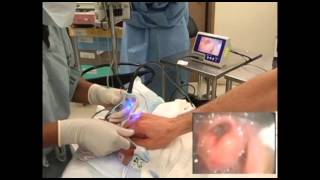 GlideScope Pediatric Airway Rounds Case Study 2 month old Inguinal Hernia Repair [upl. by Llertnad]