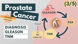 Prostate Cancer  Symptoms Diagnosis Staging Grading  Overview for Med Students [upl. by Adnaugal]