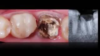 Tooth autotransplantation [upl. by Anoyi]