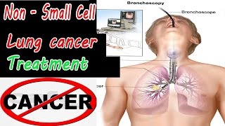 Lung cancer Non Small Cell Lung cancer Treatment 😱😱😱 [upl. by Leirbma97]