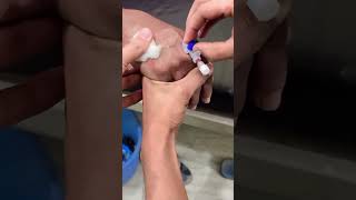 Live procedure of iv cannula Insertion  iv cannulation Technique in hindi [upl. by Devon]