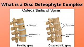 What is a Disc Osteophyte Complex [upl. by Androw182]