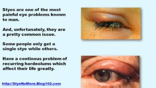 stye on eye  treatment for stye in eye  eye stye home remedies [upl. by Kiel]