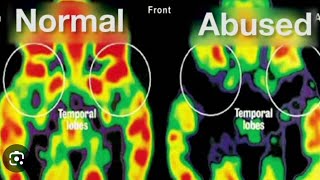 Complex PTSD vs PTSD [upl. by Orrocos]