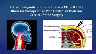 Ultrasoundguided Cervical Cervicis Plane CCeP Block [upl. by Teahan]