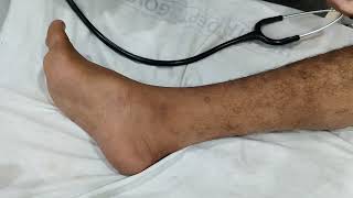 Bilateral Hyperreflexia and Ankle Clonus [upl. by Dilisio]