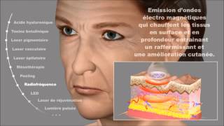 Amélioration cutané par radiofréquence Rajeunissement du visage Dermatologue Montpellier [upl. by Haliled]