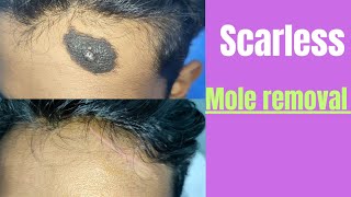 Scarless mole removal Hairy nevus removal  Totally scarless [upl. by Southworth]