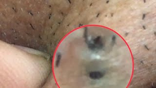 Twin cystic blackheads [upl. by Coyle]