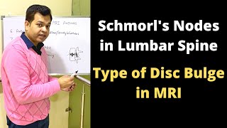 What are Schmorls Nodes in MRI Disc Bulge Lumbar Spine MRI Types of Herniated Disc shorts [upl. by Beberg790]