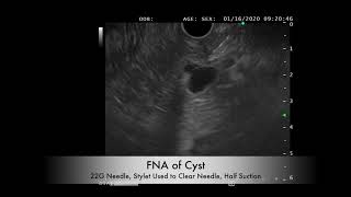 EUS FNA of a Pancreas Body Side Branch IPMN with Low Risk Features [upl. by Seumas909]