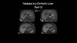 Nodules in a Cirrhotic Liver  Part 11 radiology radiologist cirrhosis liverdisease liverhealth [upl. by Naehgem]