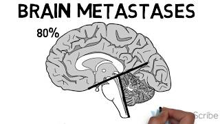 Brain Metastases [upl. by Busby]