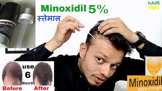 apply Minoxidil properly to best result hair tips [upl. by Glogau795]