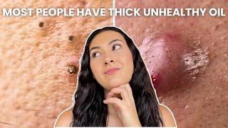 How To Treat Every Type of Acne Comedones Nodules Cysts [upl. by Enirehtac]