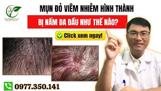 Mụn Đỏ Viêm Nhiễm Hình Thành Bị Nấm Da Đầu Như Thế Nào  ĐÔNG DƯỢC GIA TRUYỀN [upl. by Ever]