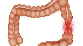 inflammation in small and large intestine stomachbest medicine in homeopathymedicircle7553 [upl. by Codding842]