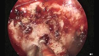 Petrous Apex Granuloma Drained Trans Nasal Endoscopic [upl. by Fisa]