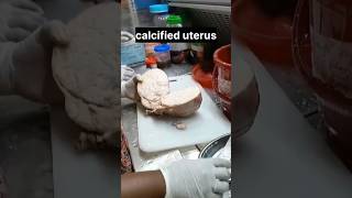 calcified uterus  histopathology [upl. by Idur]